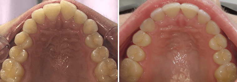 Close up of a patient's smile before and after Invisalign treatment