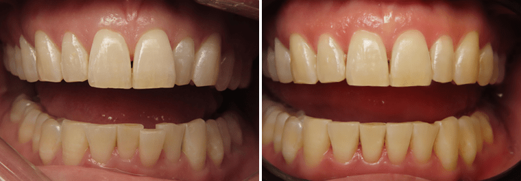 Close up of a patient's smile before and after Invisalign treatment