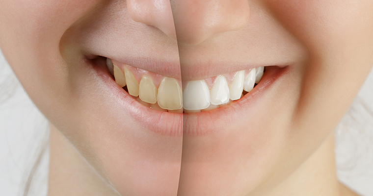 Teeth Whitening: How Soon Can I Eat Normally?